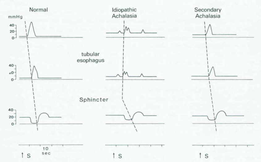 achalasia manometry